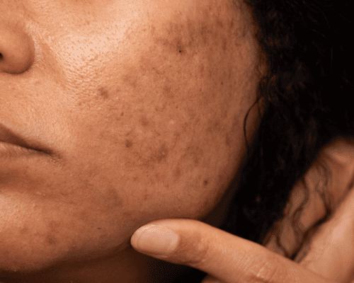 Acne Treatment in Karvenagar | Dr. Vallari Soman
