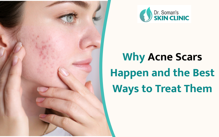 Why Acne Scars Happen and the Best Ways to Treat Them